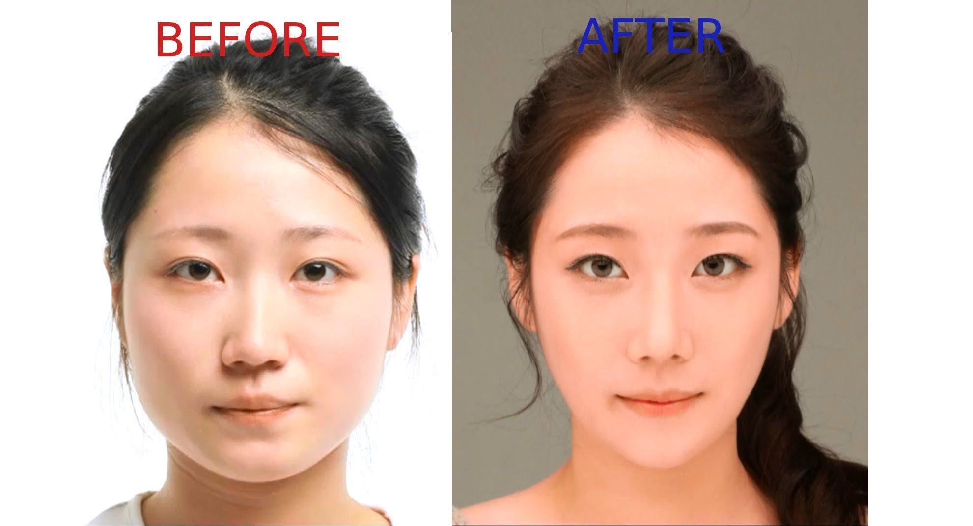Можно ли увеличить глаза с помощью пластической операции фото до и после