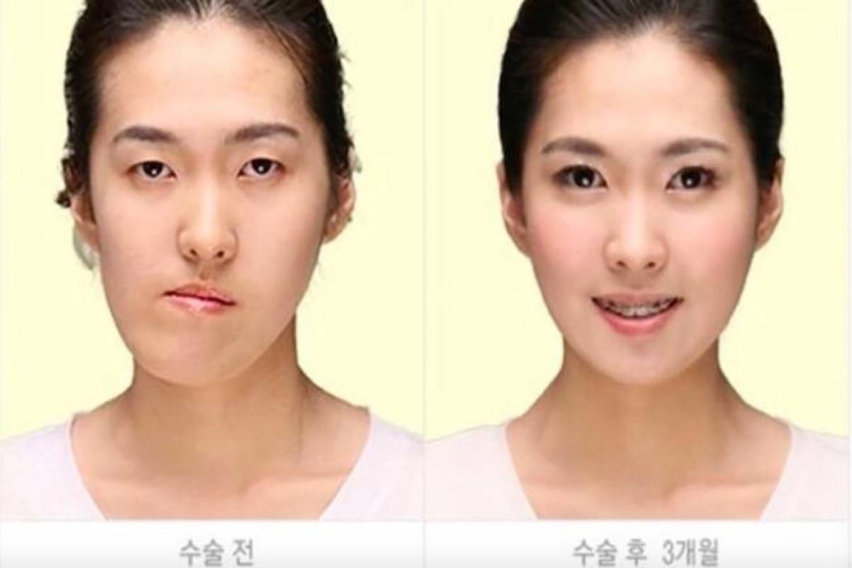Foreigners Are Charged More For Plastic Surgery In Korea Than Koreans.