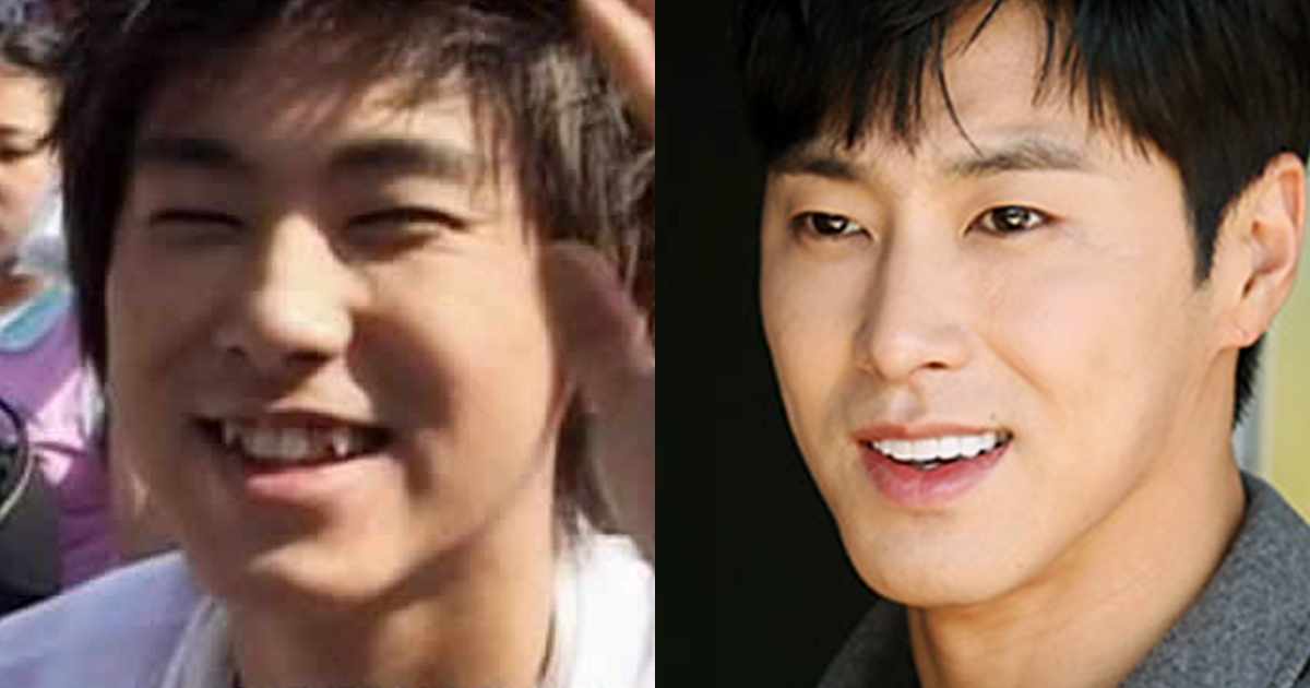 Kpop Idols Teeth Before And After | K-Pop Galery