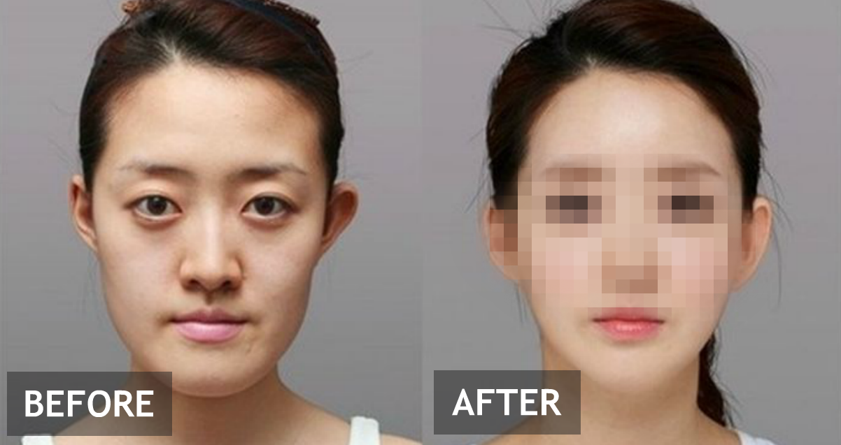 korean plastic surgery before and after gone wrong